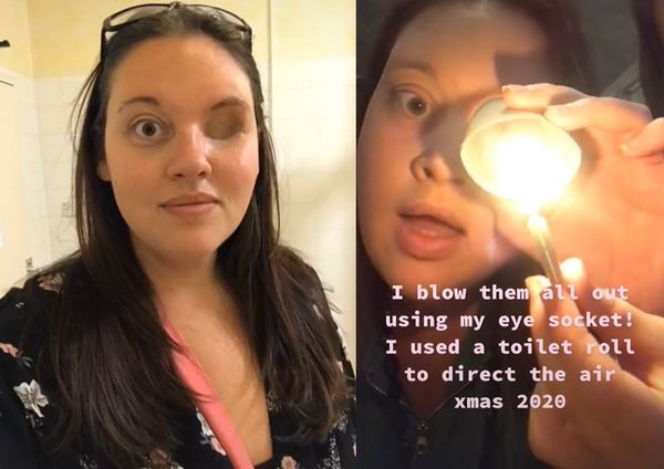 女子罹癌后失左眼 苦练眼洞吹蜡烛绝技