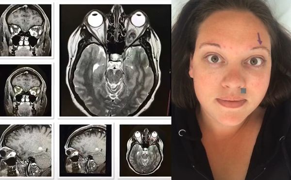 女子罹癌后失左眼 苦练眼洞吹蜡烛绝技