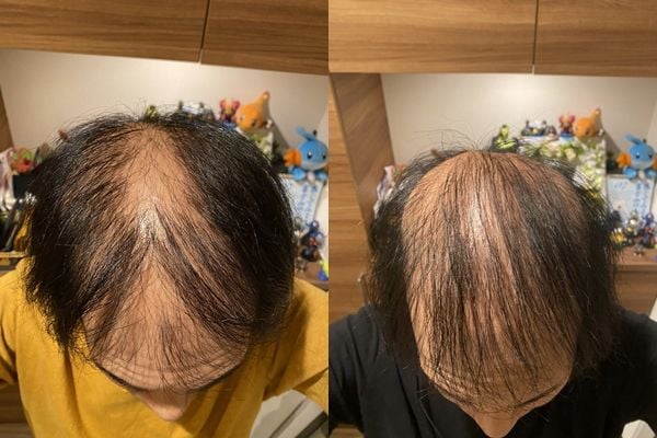 帅哥打莫德纳狂掉发 自爆百天变秃头