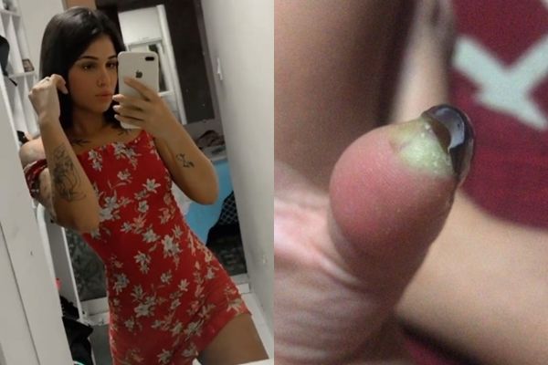 正妹做美甲被感染 拇指流脓惨被截肢