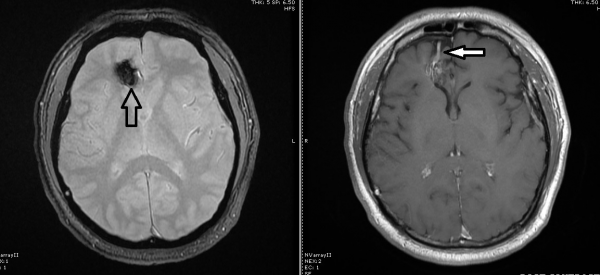脑神经外科兼脊柱专科医生盛晓峰／市场经理海绵状血管瘤 只要保守治疗，不需开刀切除