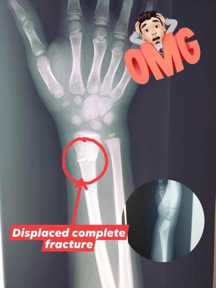 8岁童弄伤手腕去推拿 原来是骨裂手险变废 