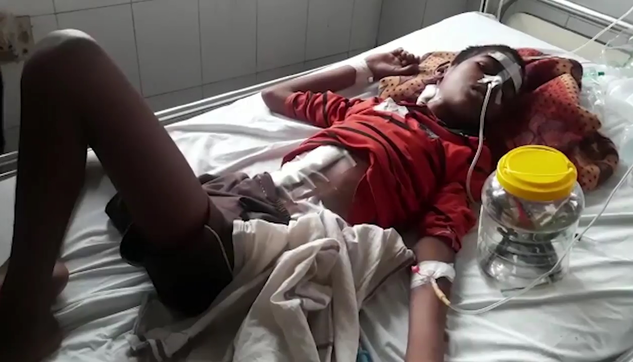 医生为腹痛少年动手术 取出16支牙刷铁钉