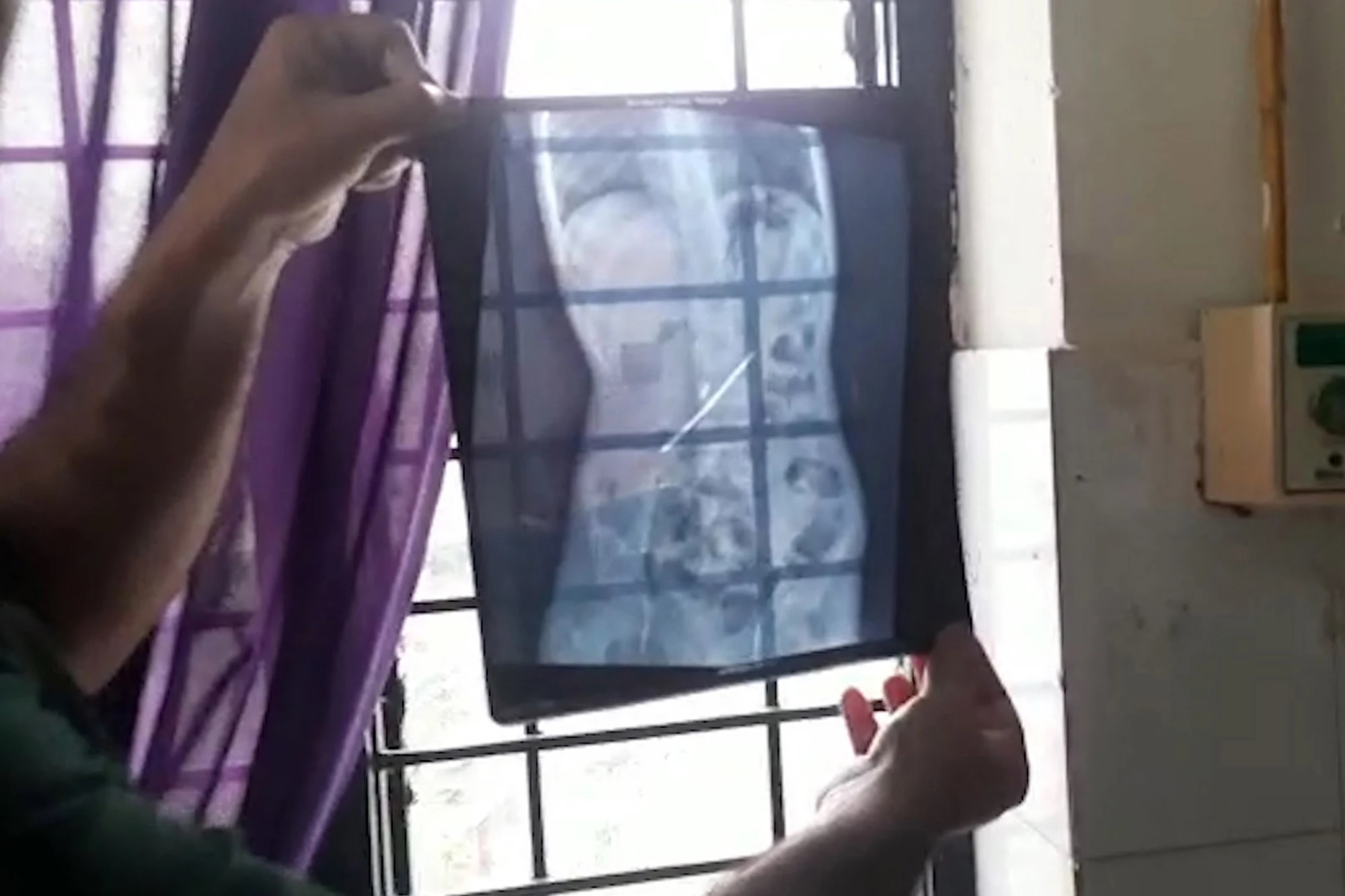 医生为腹痛少年动手术 取出16支牙刷铁钉