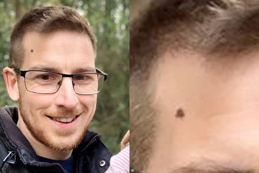 妈妈眼尖救儿一命 男子脸上痣变癌