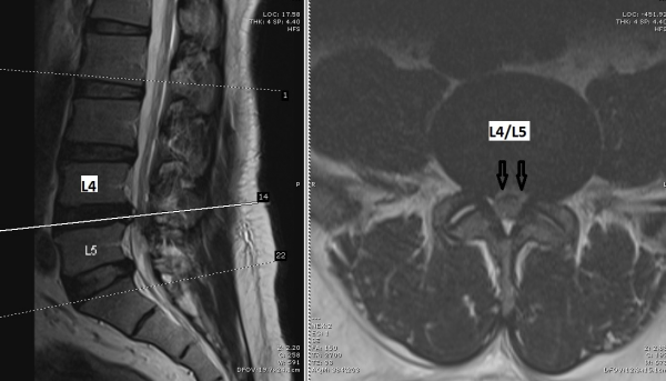 脑神经外科兼脊柱专科医生盛晓峰／椎间盘胶质凸出致马尾症候群 缅甸移工须以轮椅代步