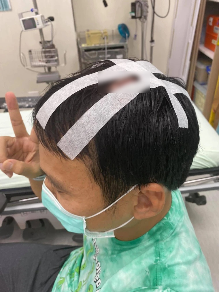 艾力克斯长太高撞破头 曝5公分惊悚血痕照