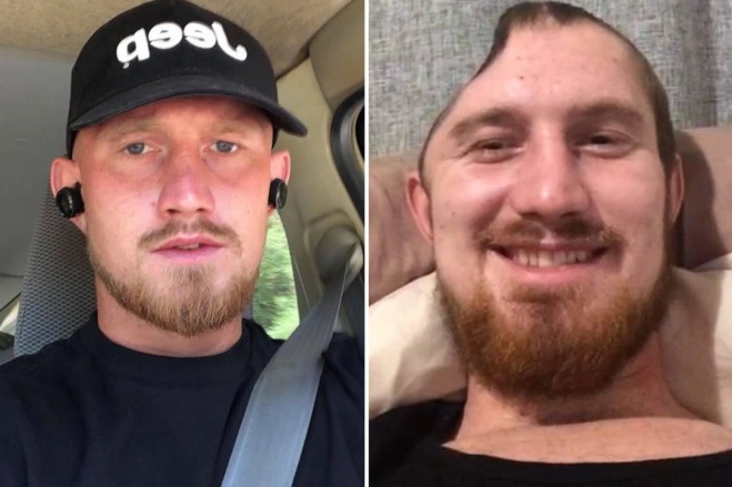 被打到脑出血头骨削半 男子奇迹存活