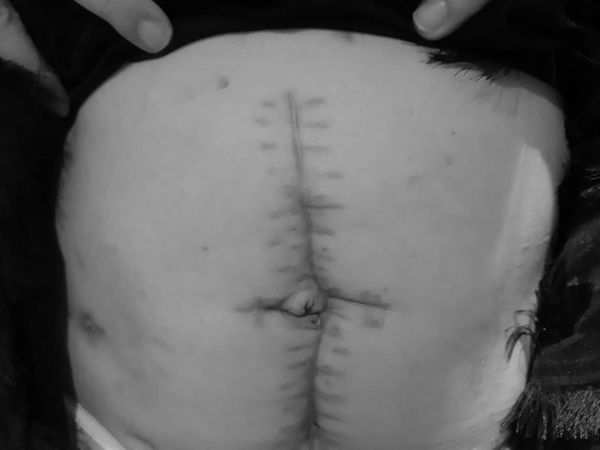 减肥过度身体没脂肪 李宇柔肠爆裂鬼门关走一回	