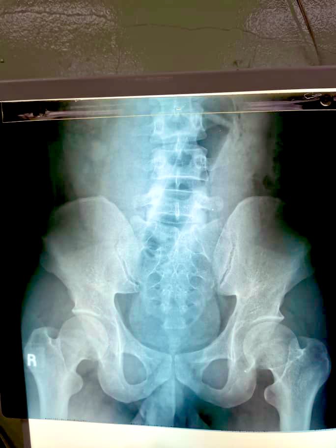 医生揭露竟有人用气泵 “自娱自乐”导致肠穿孔