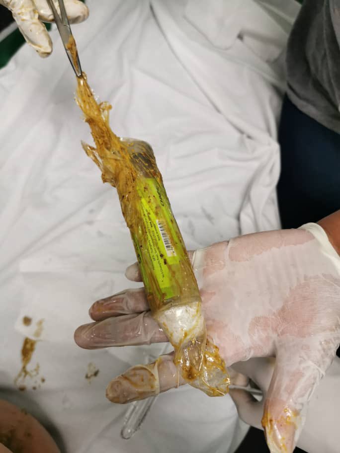 医生揭露竟有人用气泵 “自娱自乐”导致肠穿孔