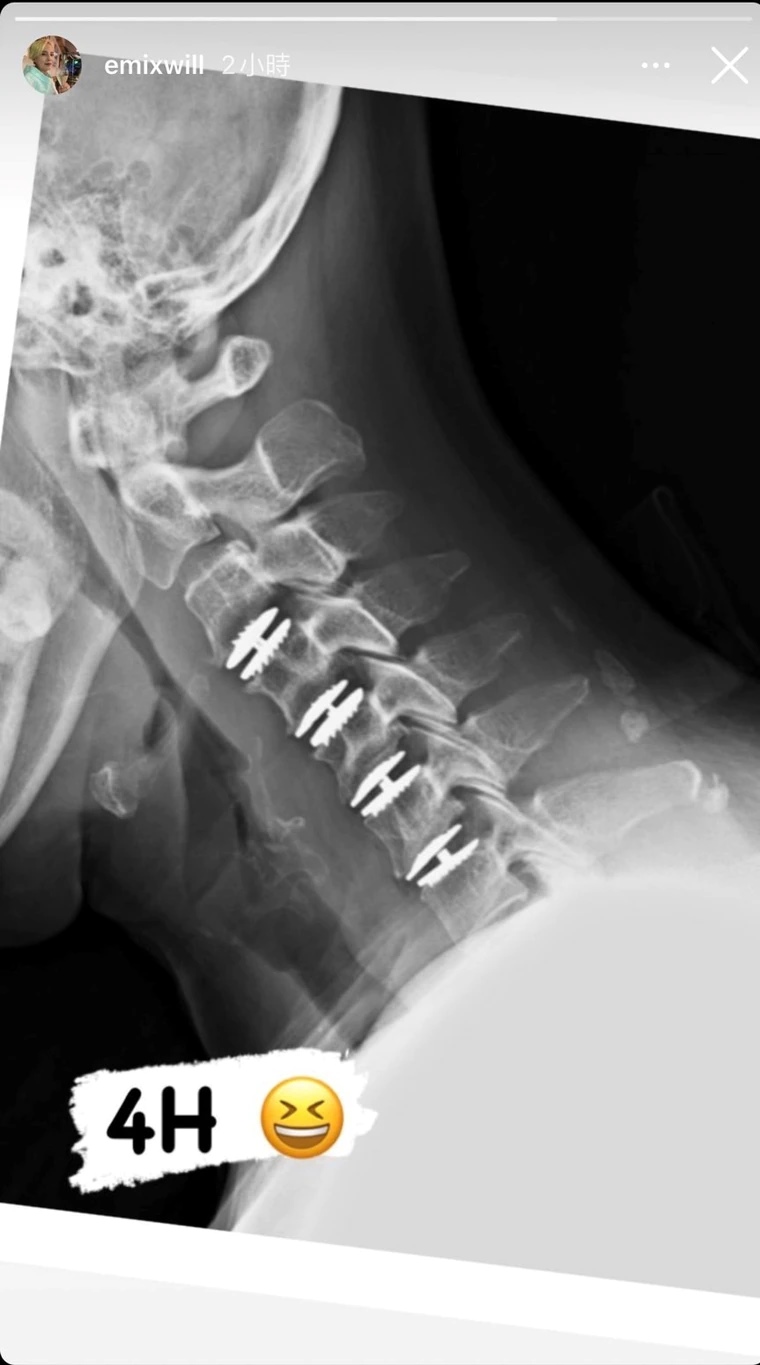 开刀前才知健保有给付 李明依多花3万怒开骂