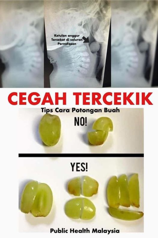 整颗葡萄可堵儿童呼吸道  公共卫生专页：需切小块或切半 