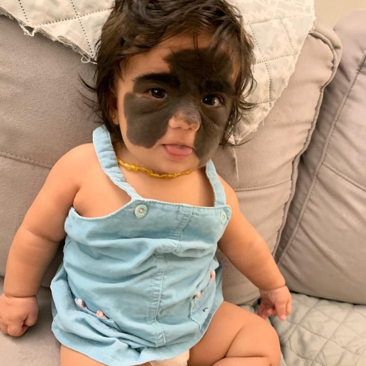 卸下2年“蝙蝠侠”胎记 女童开心“我变公主了”