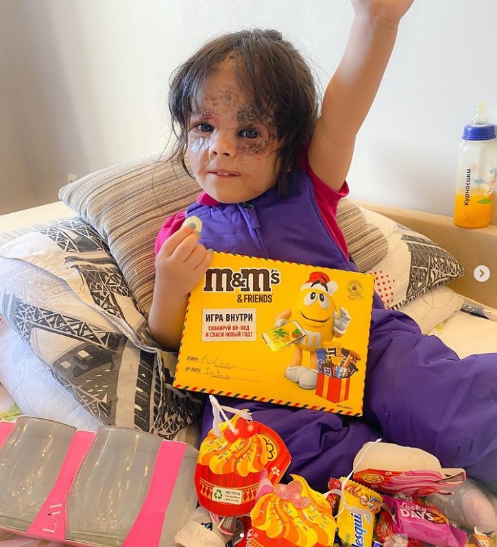 卸下2年“蝙蝠侠”胎记 女童开心“我变公主了”