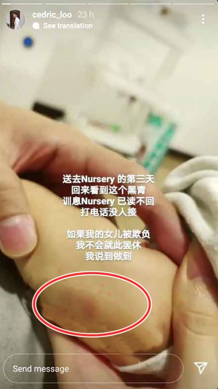 女儿送托管手脚现瘀青 吕锐心痛轰不罢休