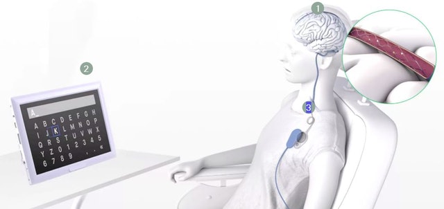 澳洲渐冻人安装“脑机介面” 用思想发布首个推文