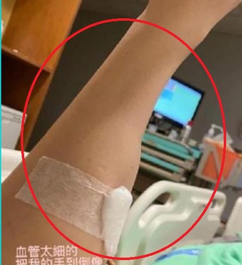 陈乔恩深夜突住院 点滴插手臂肿成2倍大