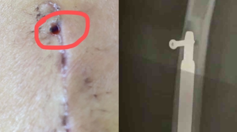 中国禁这手术她飞新加坡·花30万做4次手术仍失败