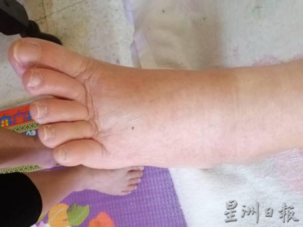 供fb：百乐高原累计20宗基孔肯雅症，住处无积水也遭殃，居民盼卫生局关注