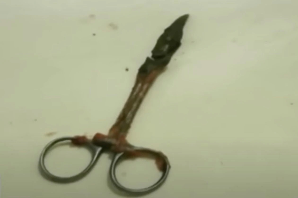 腹痛20年照X光 古董手术剪刀留肚里