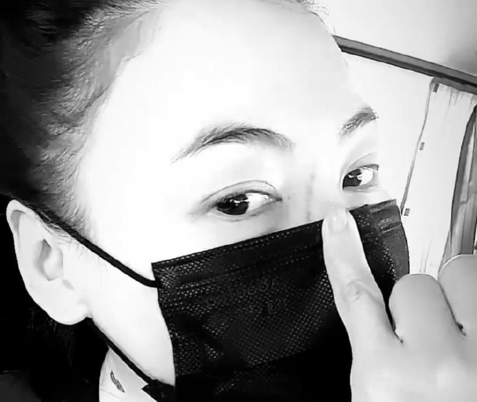 被小儿子Marcus抓伤脸伤口超长 张柏芝自称“刀疤张”