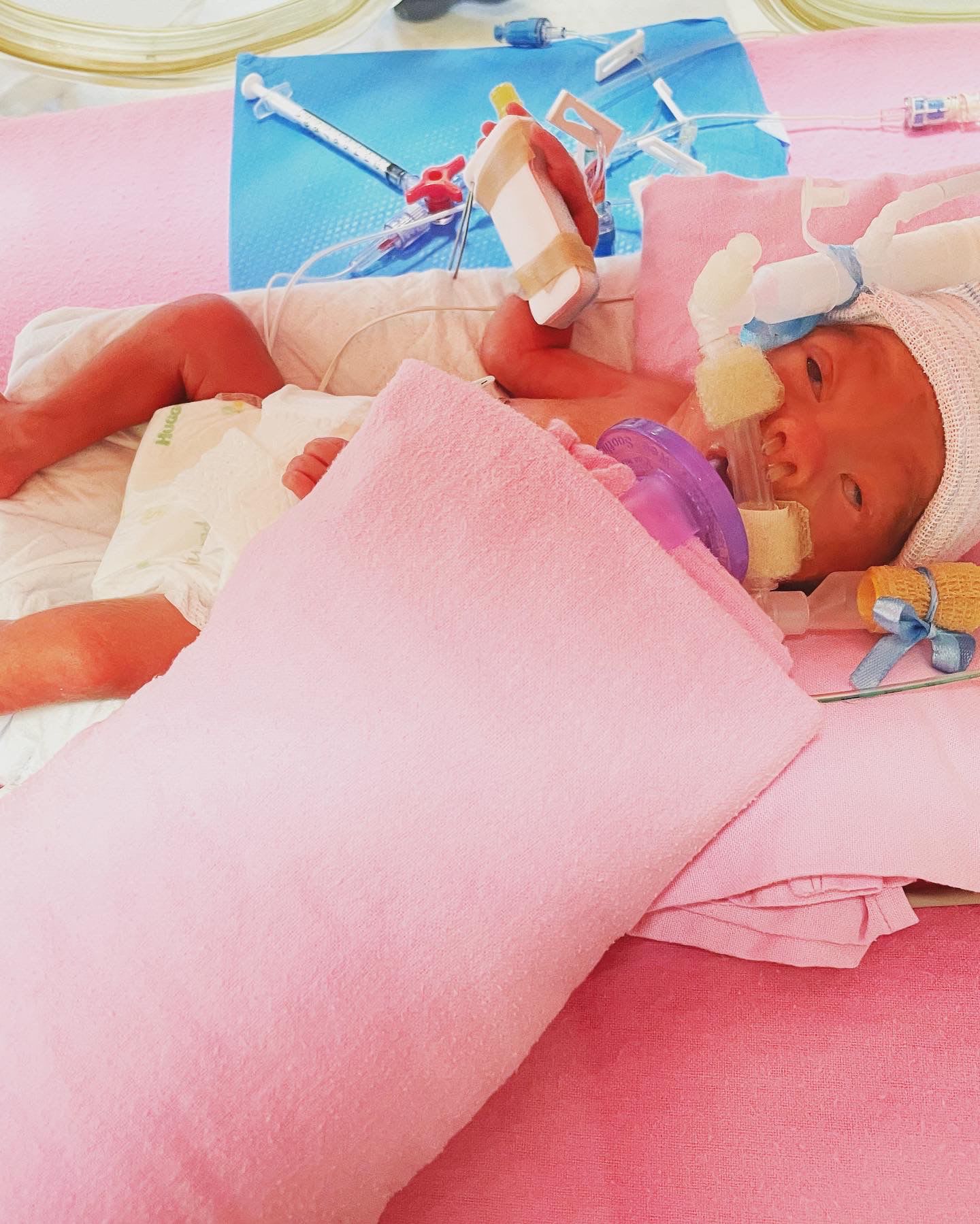 宝宝仅一公斤皮肤几乎透明 外籍孕妇狮城早产网上求助