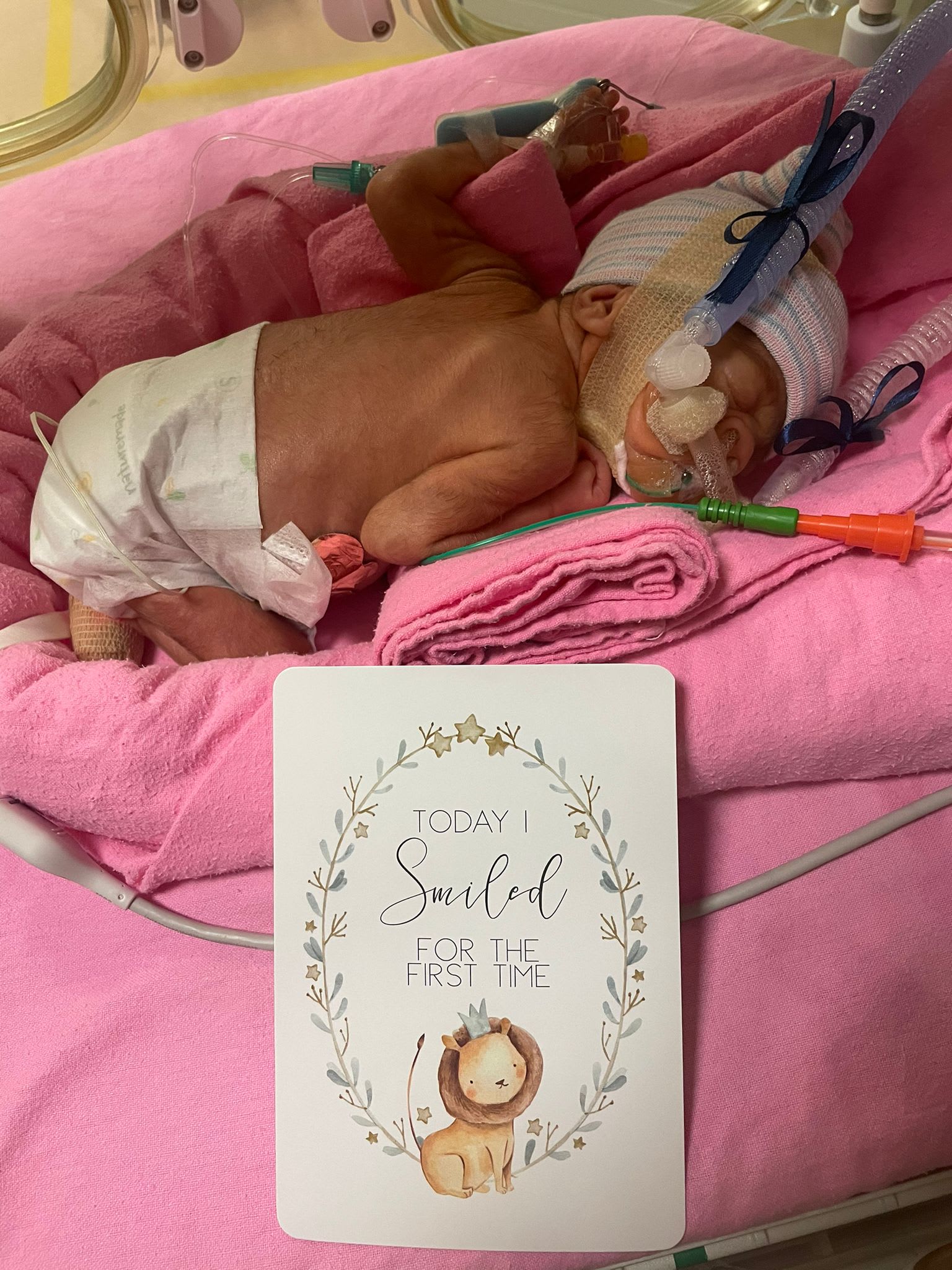 宝宝仅一公斤皮肤几乎透明 外籍孕妇狮城早产网上求助