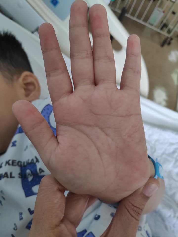 男童确诊轻微发烧一天 三四星期后现危险后遗症