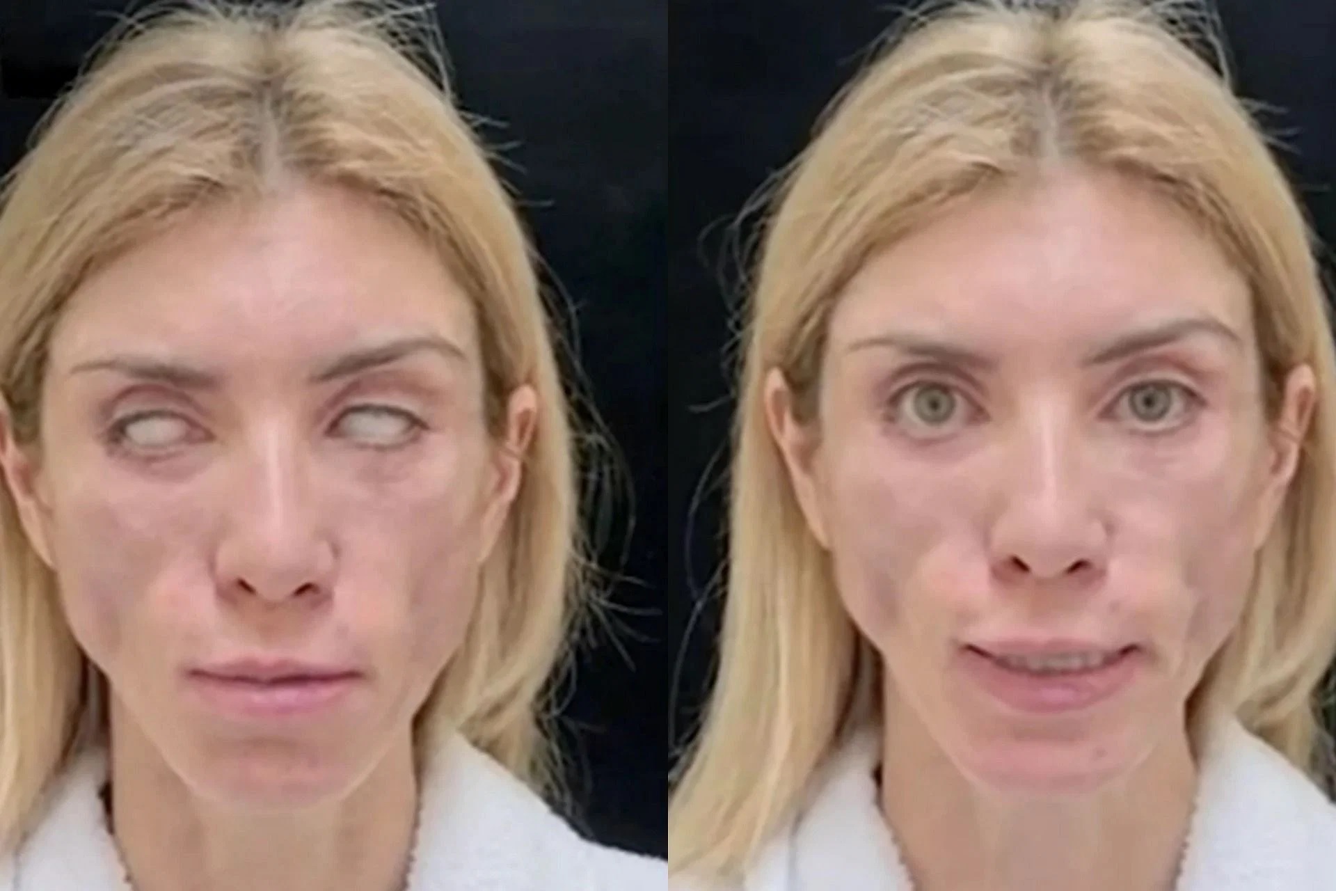 选美女王花钱整型 惨变僵尸脸无法闭眼