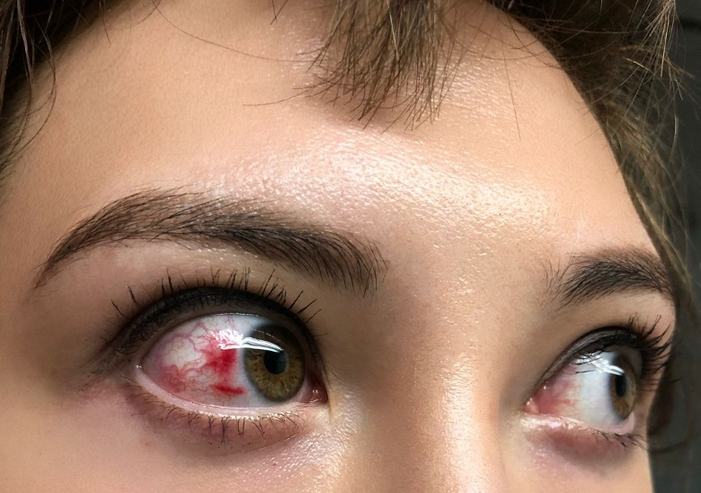 《飞虎3》|何慈茵枪战出意外 弹片击中眼爆微丝血管