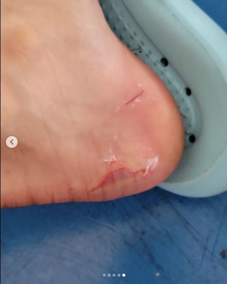 厕所马桶水箱砸伤脚  小潘伤势无碍心有余悸