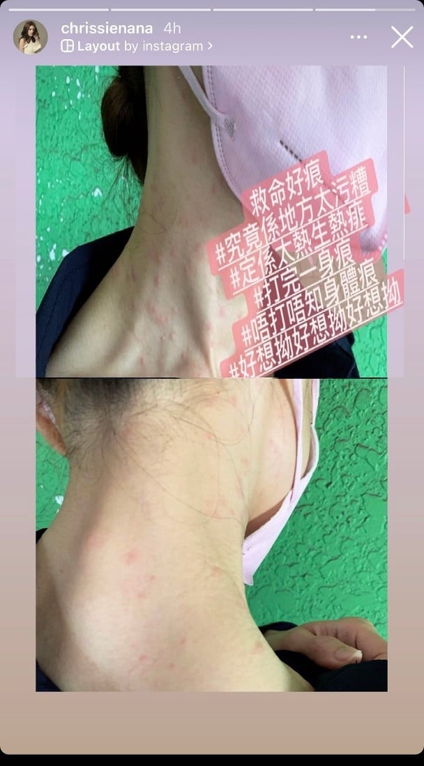 吊完钢丝身上爆红点 周秀娜:救命好痒!