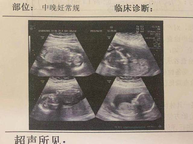 拚图两图)山东四胎孕妇罕见多次分娩 头2婴隔4天出世2个仍留腹中