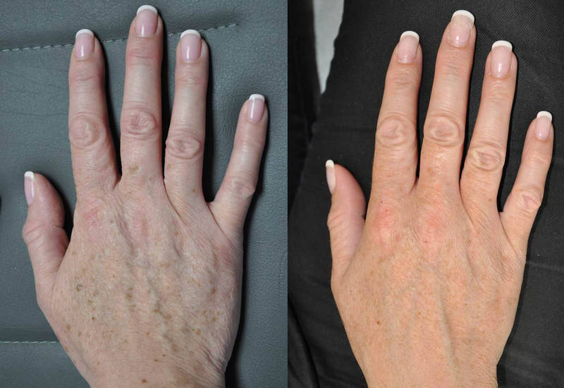 拚图)成功实现人类皮肤“逆龄” 研究:可年轻30岁