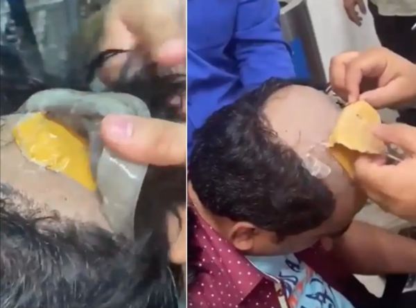 拼盘/印度男靠秃顶藏百万走私黄金 假发整片掀起 直肠内还塞2包