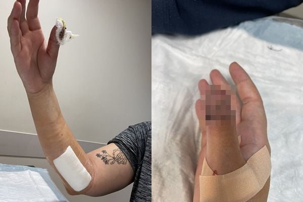 指甲长诡异褐线10年 检查才知是罕见皮肤癌