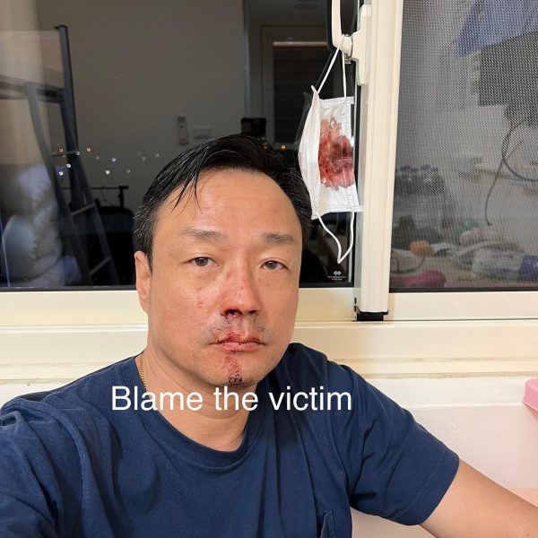 王喜曝拒止血真相  晒黑白照被骂翻