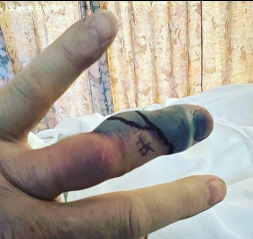 男星整理庭院被响尾蛇咬  差点小命不保