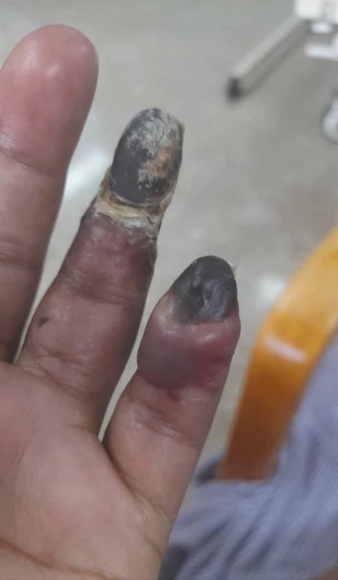 疑加强剂影响,单亲妈妈再增一手指坏死/2图