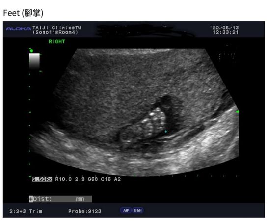 女星怀孕吃生食惊染弓浆虫 忧生畸形儿背夫偷哭