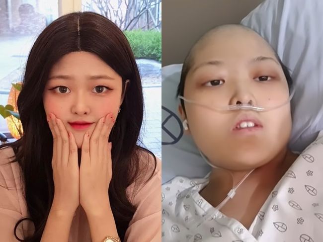拼盘/21岁YouTuber患末期卵巢癌 萌妹变光头拍最后影片:恐剩1周可活