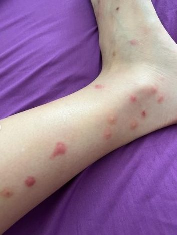 被木虱狂咬1个月  朱智贤饱受失眠兼发噩梦