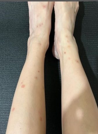 被木虱狂咬1个月  朱智贤饱受失眠兼发噩梦