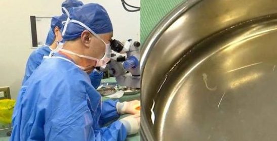 两岁小童眼睛爬出寄生虫钻 与犬类有过密接史