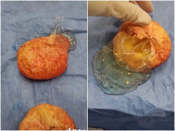 假胸植入36年矽胶发黄流汁 整形医生网友纷看傻