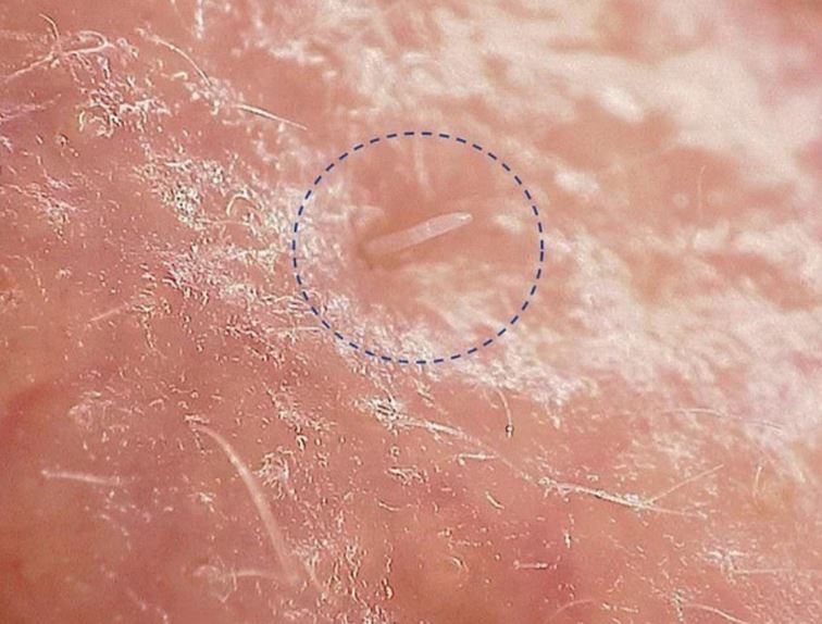 拼盘 研究:人类毛孔住满八脚螨虫 近亲繁衍基因改变