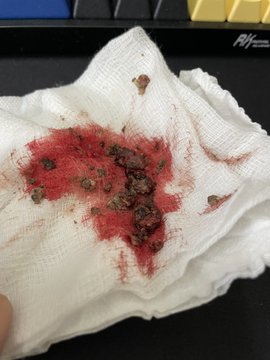 时常嗅到异味找耳鼻喉 男子:原来鼻生石!