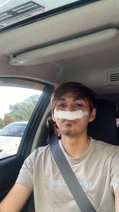 时常嗅到异味找耳鼻喉 男子:原来鼻生石!