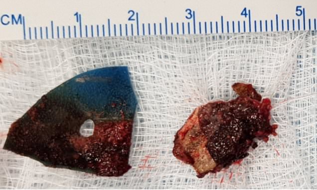 时常嗅到异味找耳鼻喉 男子:原来鼻生石!